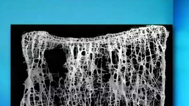 Ch@t : L'ostéoporose