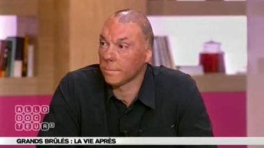 Brûlures : un travail psychologique ?