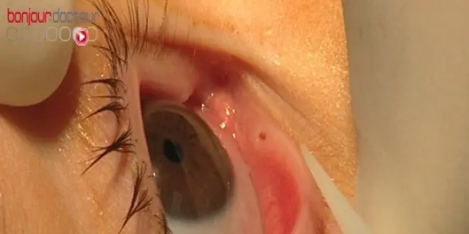 Un gène de la myopie identifié