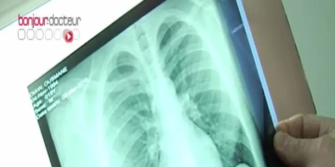 Dépistage de la tuberculose en Seine-Saint-Denis