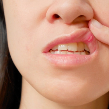 Aphtes : les ulcères de la bouche