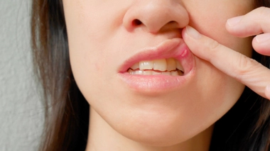 Aphtes : les ulcères de la bouche