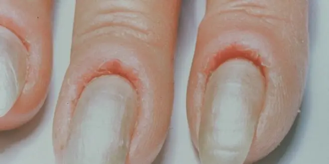 L'infection bactérienne