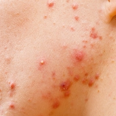 Acné : traiter les boutons, mais aussi leurs séquelles