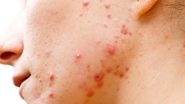 Acné : traiter les boutons, mais aussi leurs séquelles