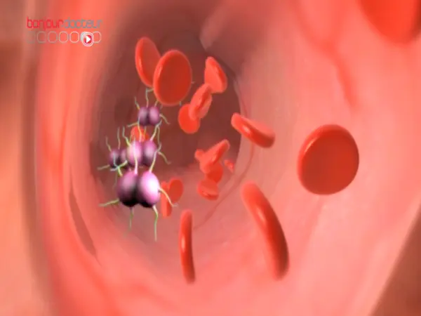 Méningite : quand la bactérie infecte les méninges