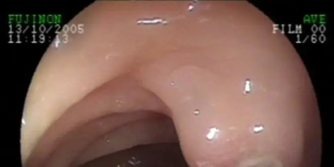 Polype dans le côlon