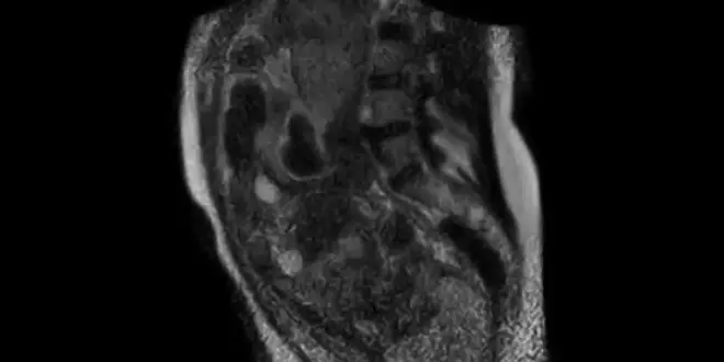 Observation de l'accouchement par IRM