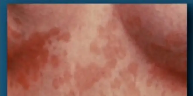 Pytiriasis versicolor