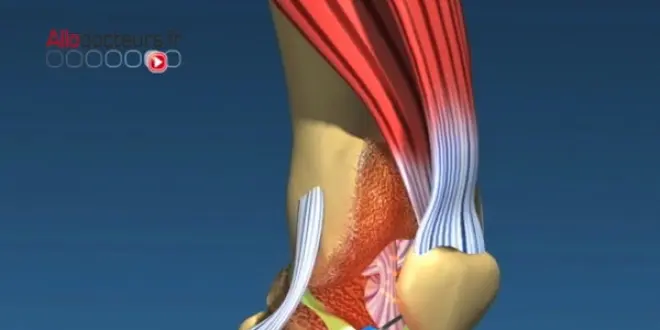 Les cellules souches sont réinjectées dans l'articulation.