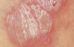 Plaque de psoriasis