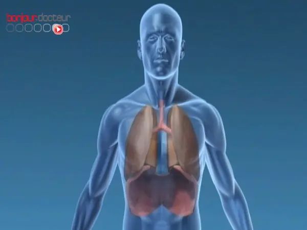 La pneumonie, une infection respiratoire aigüe