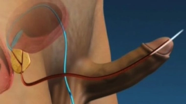 Éjaculation prématurée : comment jouer les prolongations