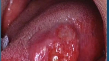 Cancer ORL : chirurgie et reconstruction