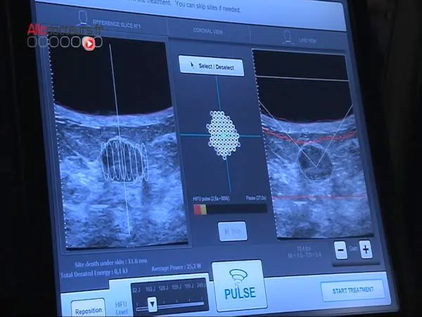 Le traitement se fait sous contrôle échographique.