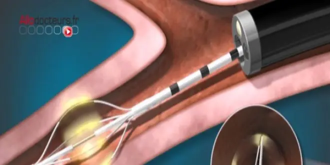 Asthme sévère : l'espoir de la thermoplastie