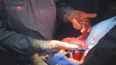 Cancer de l'oesophage : les dégâts du tabac et de l'alcool