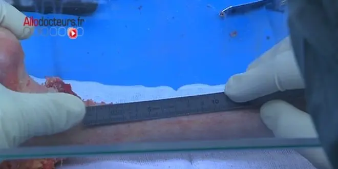 Les dimensions des greffons sont choisies pour s'adapter à celles de l'os du receveur.