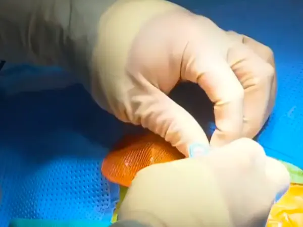 Une enveloppe antibactérienne résorbable autour des pacemakers