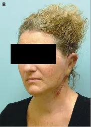 Quatre mois après l’opération, il n’y avait eu aucune complication, ni rejet.