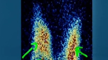 Ch@t : Les dysfonctionnements thyroïdiens