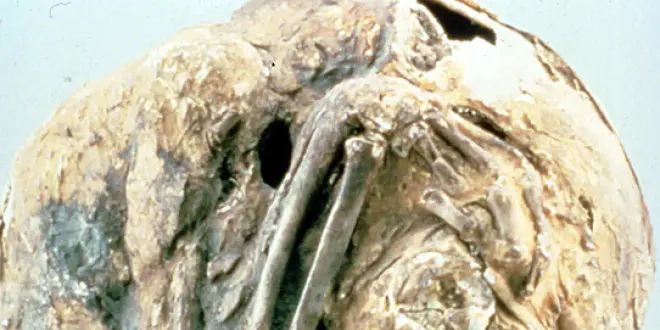 Détail d'un lithopédion conservé par les archives médicales militaires des États-Unis. Celui-ci est resté 55 ans dans le ventre de sa porteuse. (Source : Otis Historical Archives of ''National Museum of Health & Medicine'' cc-by-sa)
