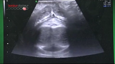 Echographie du point G