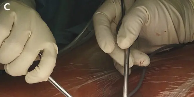 Le fragment osseux a été récupéré par voie chirurgicale (incision du scrotum).