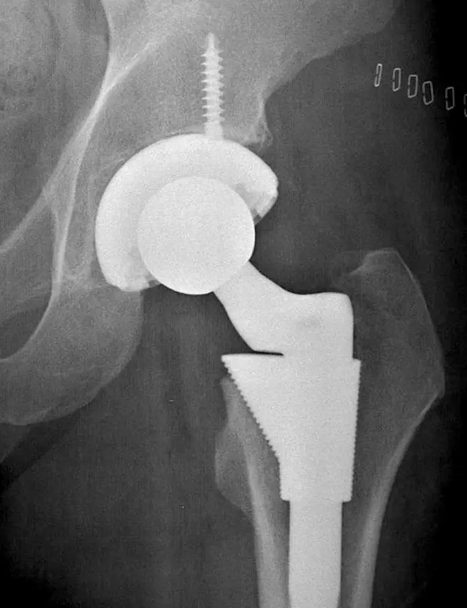 Radiographie d'une prothèse de hanche. (cc-by-sa KimvdLinde)