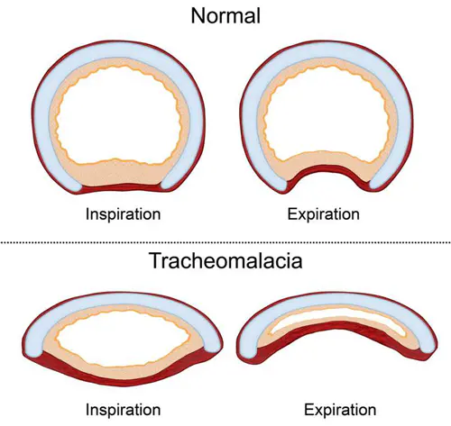 Affaissement de la trachée dans les cas de trachéomalacie (source : unité des voies aériennes du centre hospitalier universitaire vaudois - CHUV)