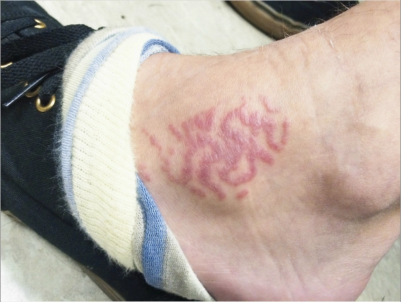 Le pied d'un plongeur, une semaine après s'être blessé sur un récif de coraux 