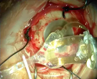 Pose de l'implant. Il sera ensuite placé sous la rétine. Copyright : Second Sight Medical Products Inc.