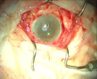 L'implant est en place. On l'aperçoit sous la rétine. Copyright : Second Sight Medical Products Inc.