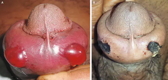 Source : New England Journal of Medicine