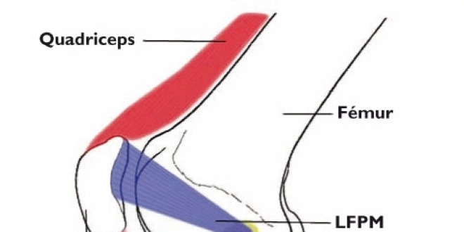 LFPM : ligament fémoro patellaire médial; LLI : ligament latéral interne