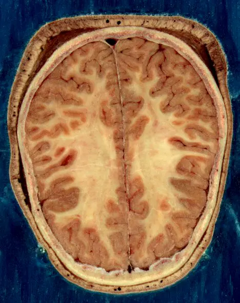 Vision d'un cortex cérébral méttant en évidence la matière blanche ©National Library of Medicine
