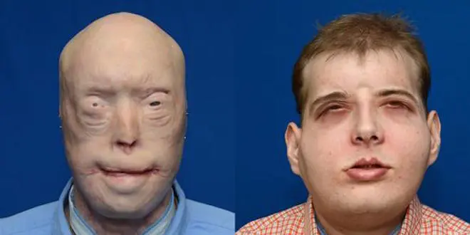 Les dernières avancés ont lieu aux États-Unis avec, en 2015, la transplantation la plus complète à ce jour.