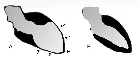 Schémas du ventricule gauche au cours d'un tako-tsubo (A), comparé à un ventricule gauche normal (B). (cc-by-sa J. Heuser)