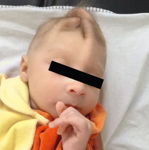 Chez cet enfant, le cerveau microcéphale a arreté son développement, mais pas la peau du crâne