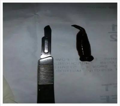 ©The International Journal of Surgery Case Reports