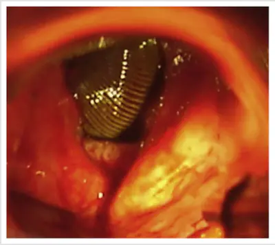 Nasofibroscopie ©The International Journal of Surgery Case Reports