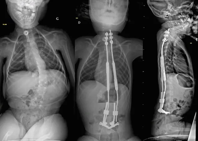 Radiographies du jeune garçon avant et après la pose des tiges fixées dans leur partie basse, dans le bassin. (CHU Amiens)