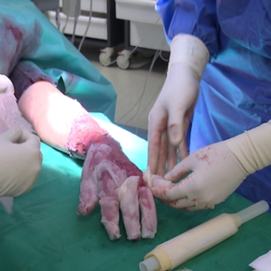 Brûlures : la prise en charge des grands brûlés