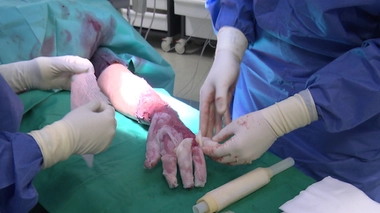 Brûlures : la prise en charge des grands brûlés