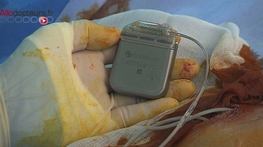 Dystonies : des contractions involontaires