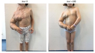 Évolution de l'état d'une patiente atteinte du syndrome CLOVES sur six mois de traitement à l'alpelisib.