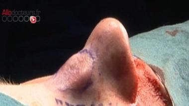 Une fracture du nez mal soignée en vaut deux !