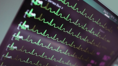 Des battements de coeur irréguliers