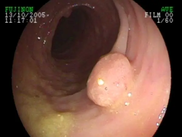 Polype dans le côlon