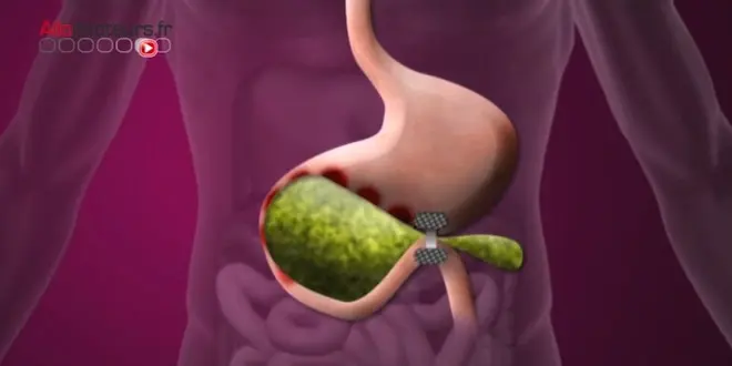 Dérivation de l'estomac dans l'intestin grêle par chirurgie endoscopique